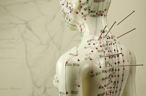 Acupuncture Near Me Stirling