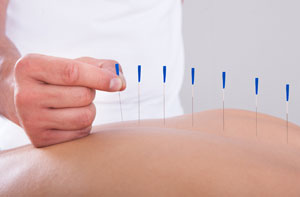 Acupuncture for Pain Relief Ilkley