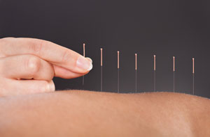 Acupuncture Irlam Greater Manchester