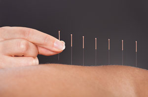 Acupuncture Market Harborough Leicestershire