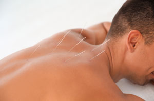 Acupuncture Chadderton Greater Manchester