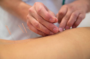 Acupuncture Pinchbeck