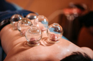 Cupping Therapy St Ives