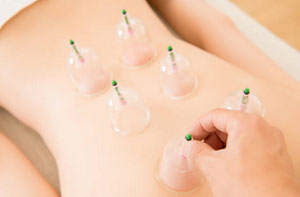 Cupping Therapy UK