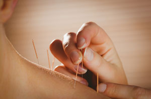 Acupuncture Near Me Brewood